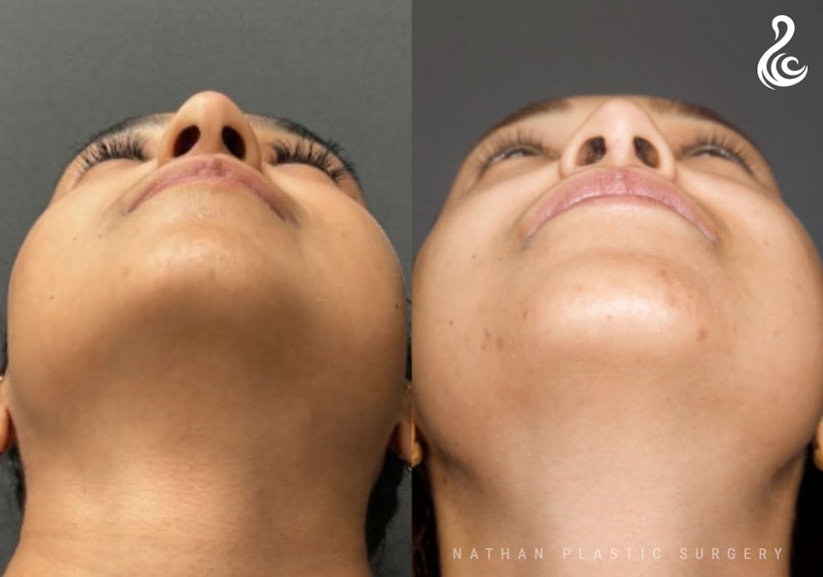 Rhinoplasty Before & After Gallery - Patient 371730 - Image 5