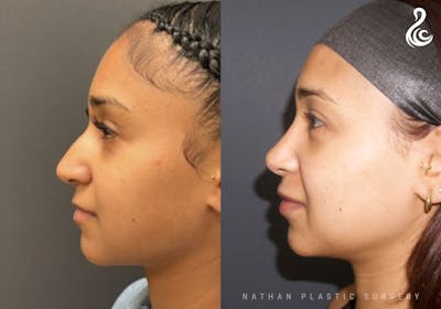 Rhinoplasty Before & After Gallery - Patient 371730 - Image 1