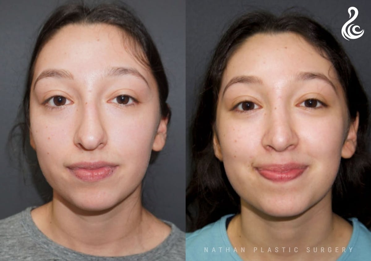 Rhinoplasty Before & After Gallery - Patient 178365 - Image 3
