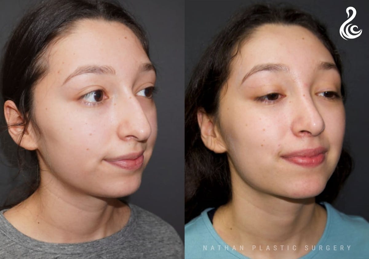 Rhinoplasty Before & After Gallery - Patient 178365 - Image 5