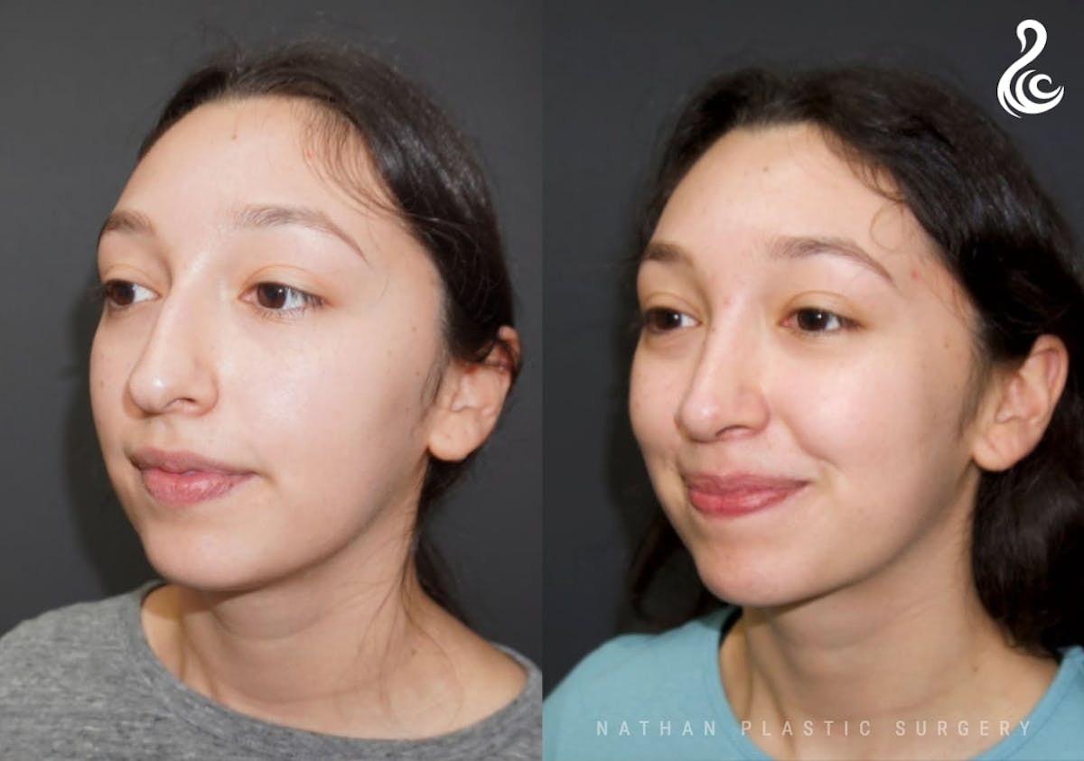 Rhinoplasty Before & After Gallery - Patient 178365 - Image 4
