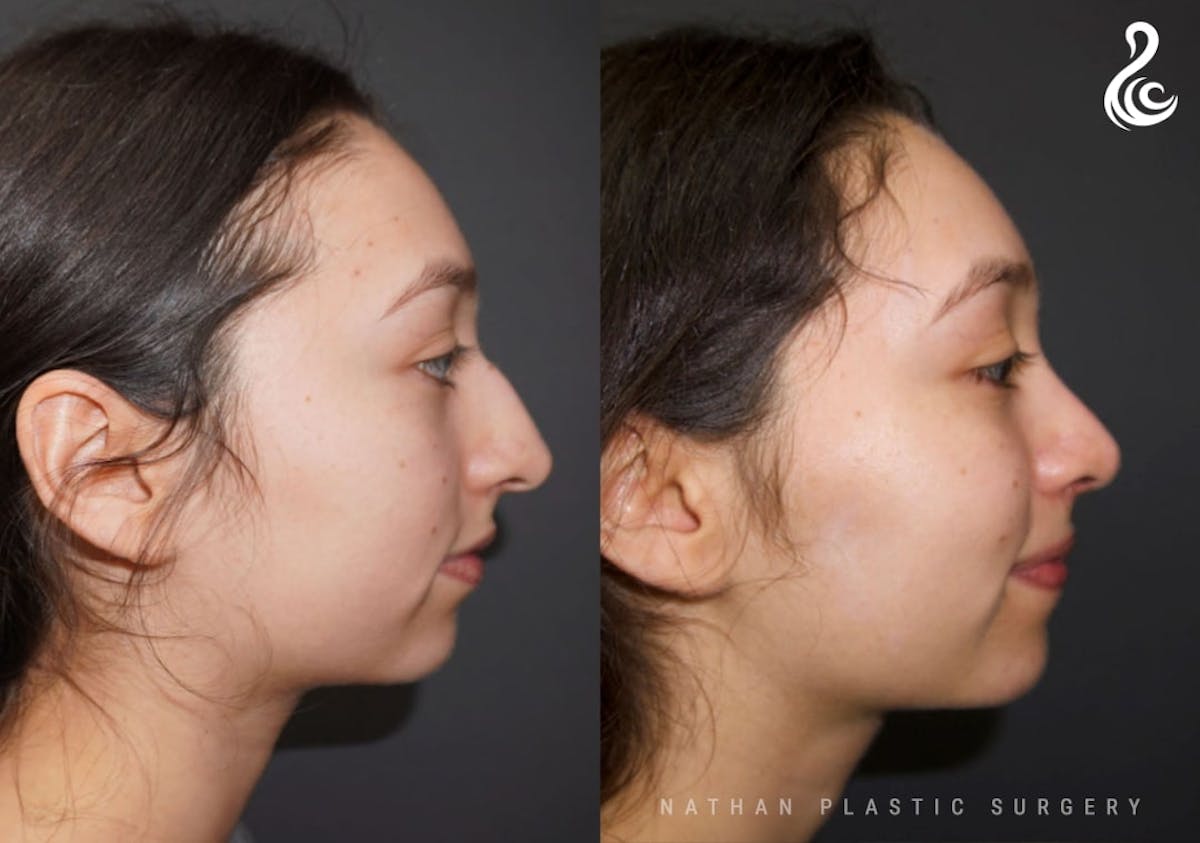 Rhinoplasty Before & After Gallery - Patient 178365 - Image 2