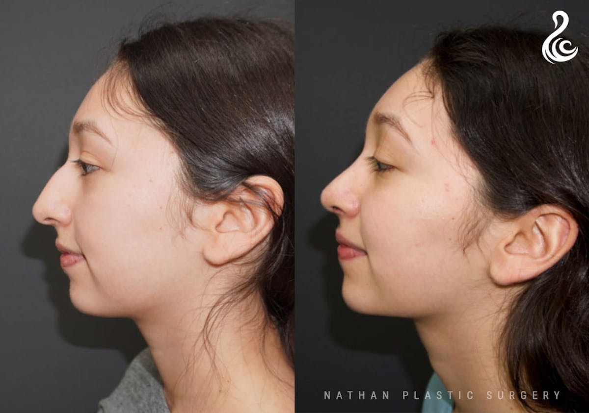 Rhinoplasty Before & After Gallery - Patient 178365 - Image 1