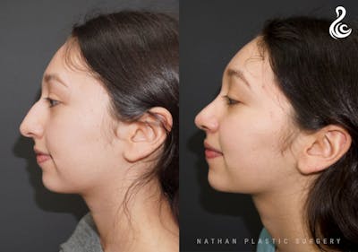 Rhinoplasty Before & After Gallery - Patient 178365 - Image 1