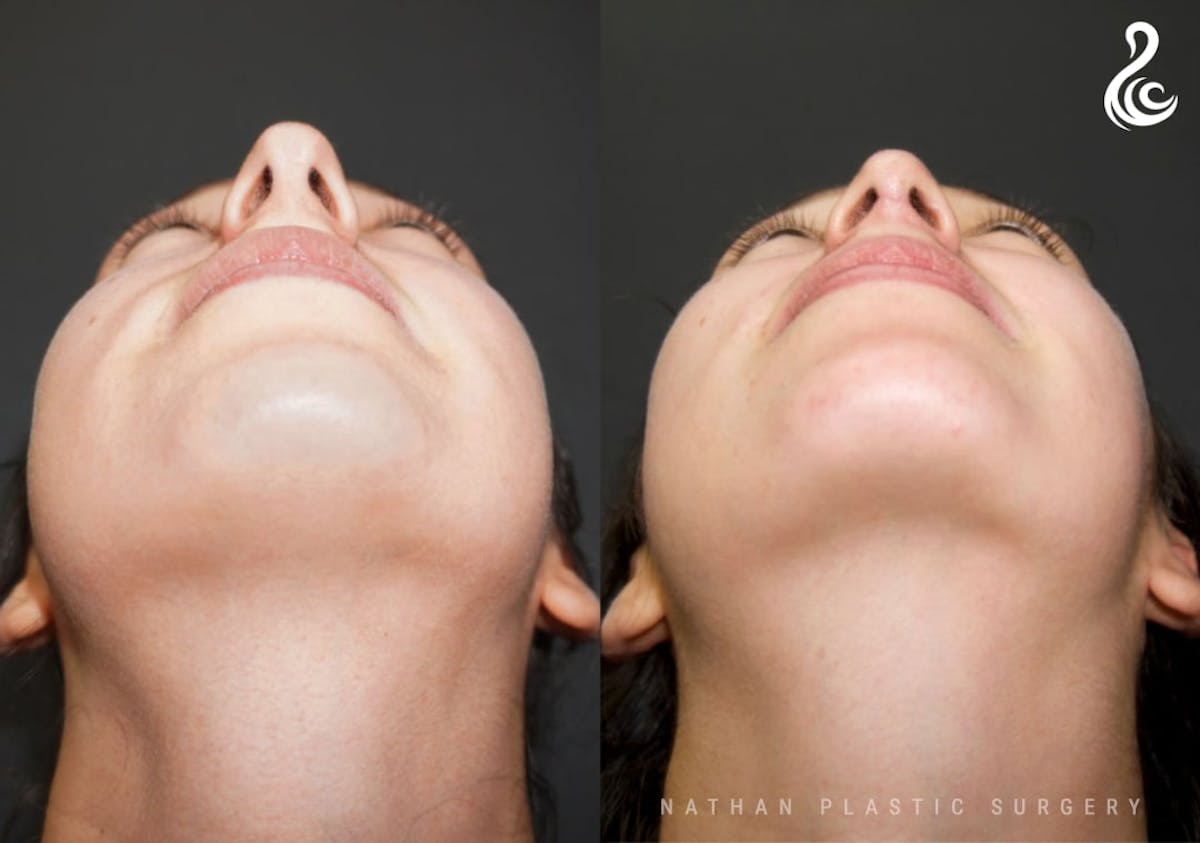 Rhinoplasty Before & After Gallery - Patient 178365 - Image 6