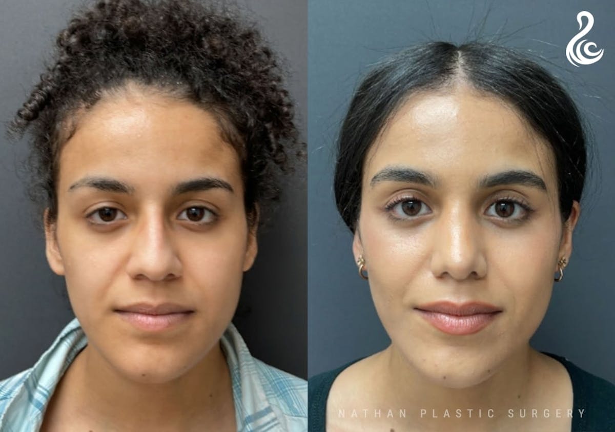 Rhinoplasty Before & After Gallery - Patient 131783 - Image 3
