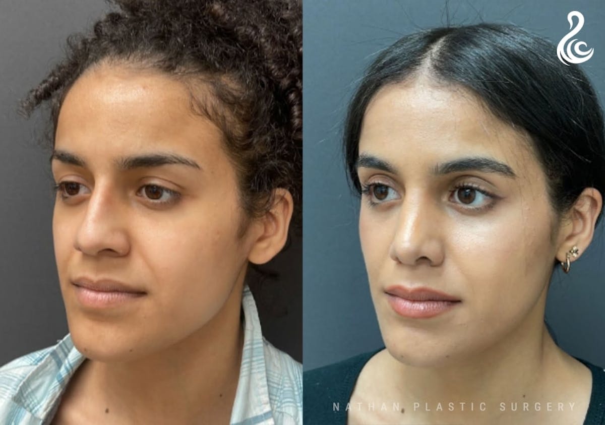 Rhinoplasty Before & After Gallery - Patient 131783 - Image 4