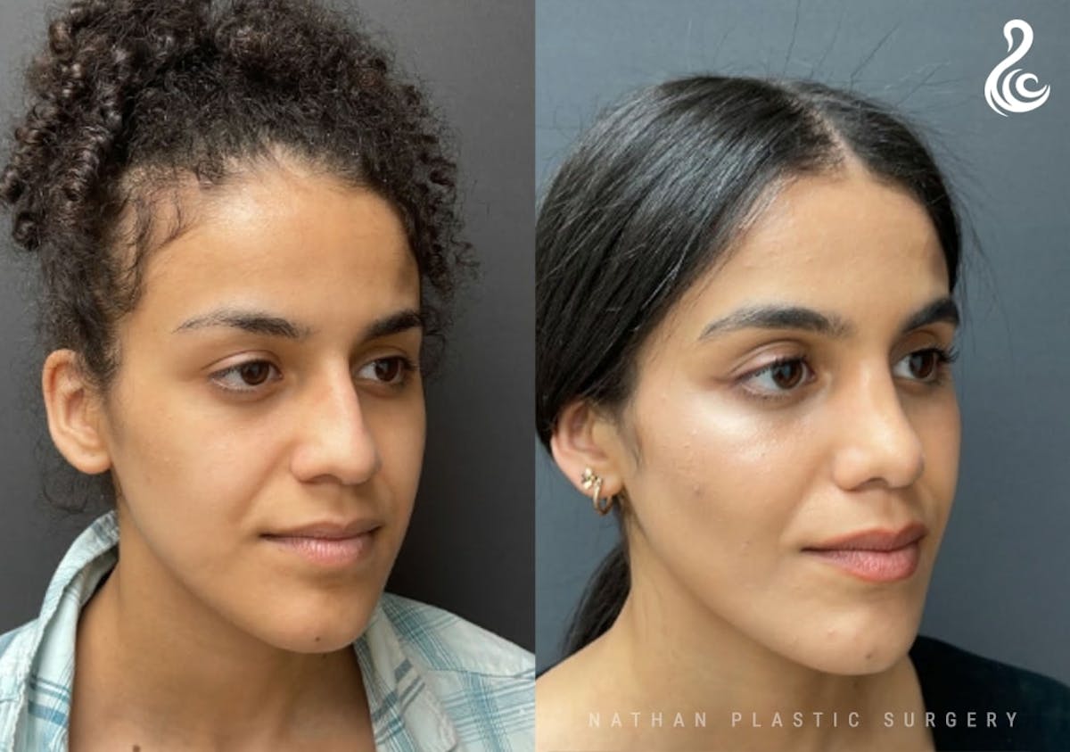 Rhinoplasty Before & After Gallery - Patient 131783 - Image 5