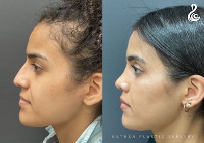 Rhinoplasty Before & After Gallery - Patient 131783 - Image 1