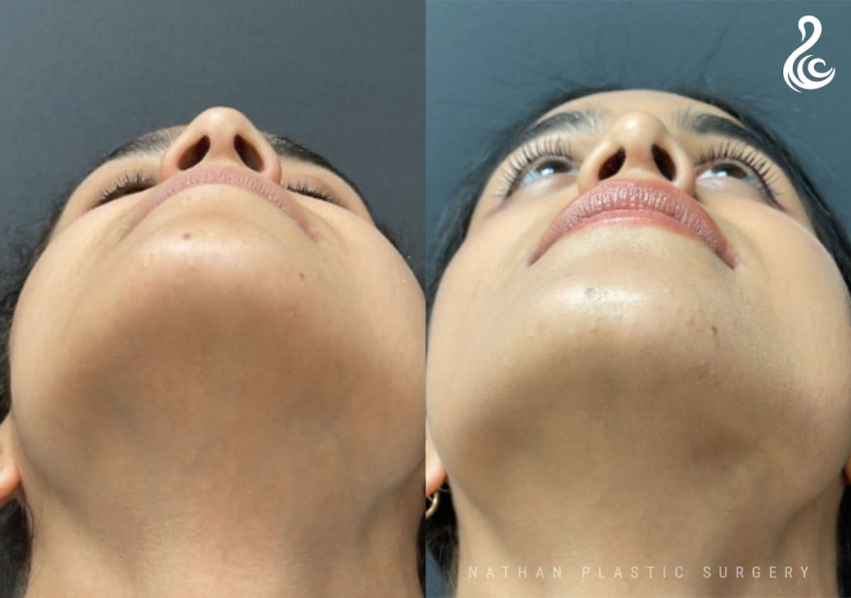 Rhinoplasty Before & After Gallery - Patient 131783 - Image 6