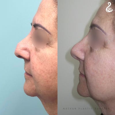 Rhinoplasty Before & After Gallery - Patient 269373 - Image 1