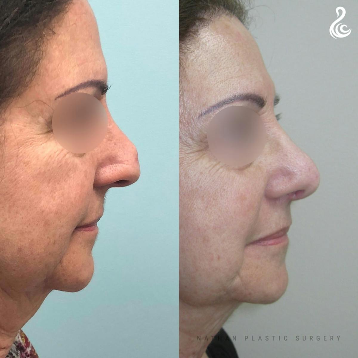 Rhinoplasty Before & After Gallery - Patient 269373 - Image 2