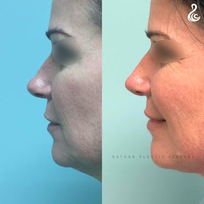 Rhinoplasty Before & After Gallery - Patient 613886 - Image 1