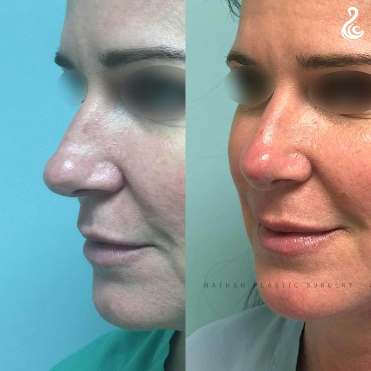 Rhinoplasty Before & After Gallery - Patient 613886 - Image 2