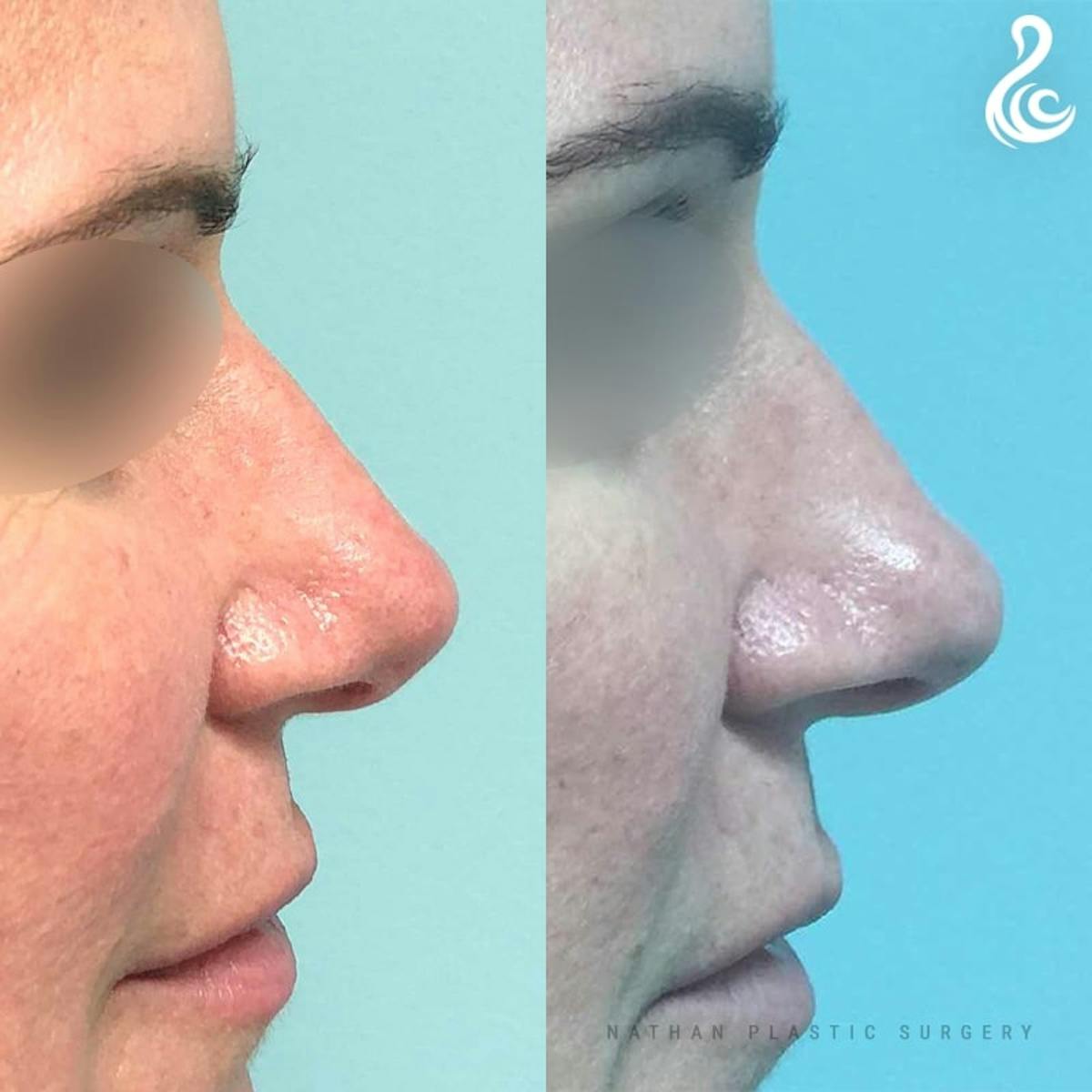 Rhinoplasty Before & After Gallery - Patient 613886 - Image 3