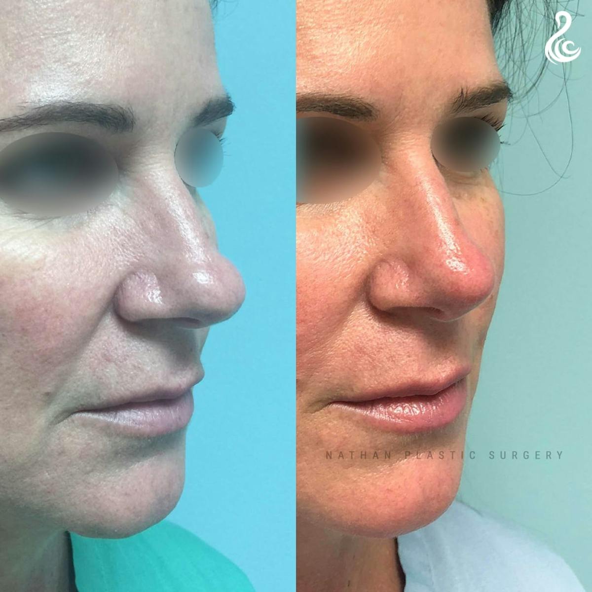 Rhinoplasty Before & After Gallery - Patient 613886 - Image 4