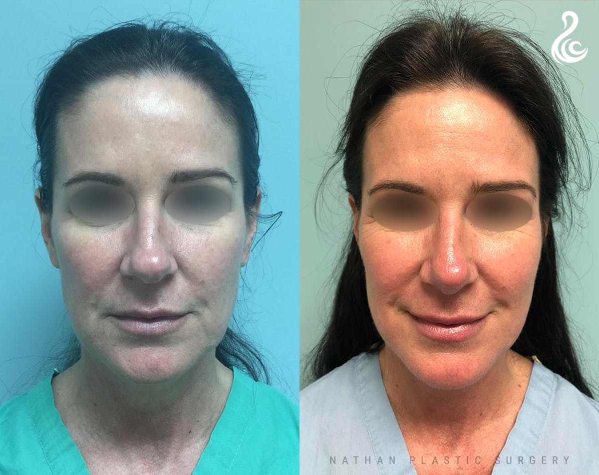 Rhinoplasty Before & After Gallery - Patient 613886 - Image 5
