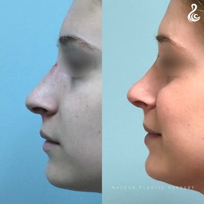 Rhinoplasty Before & After Gallery - Patient 136119 - Image 1