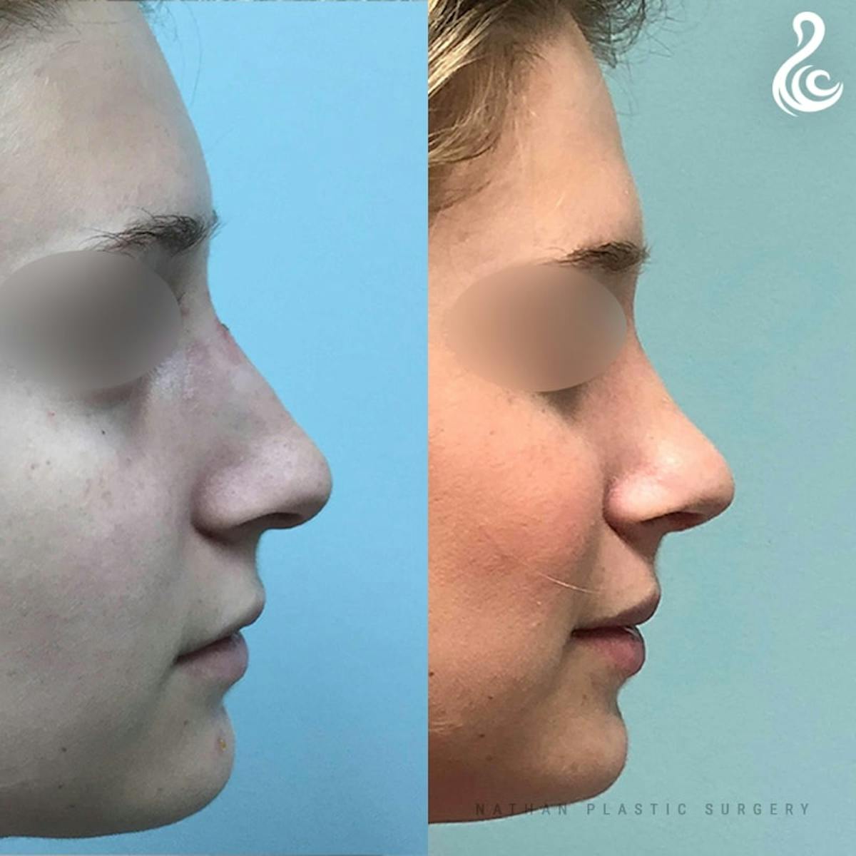 Rhinoplasty Before & After Gallery - Patient 136119 - Image 2