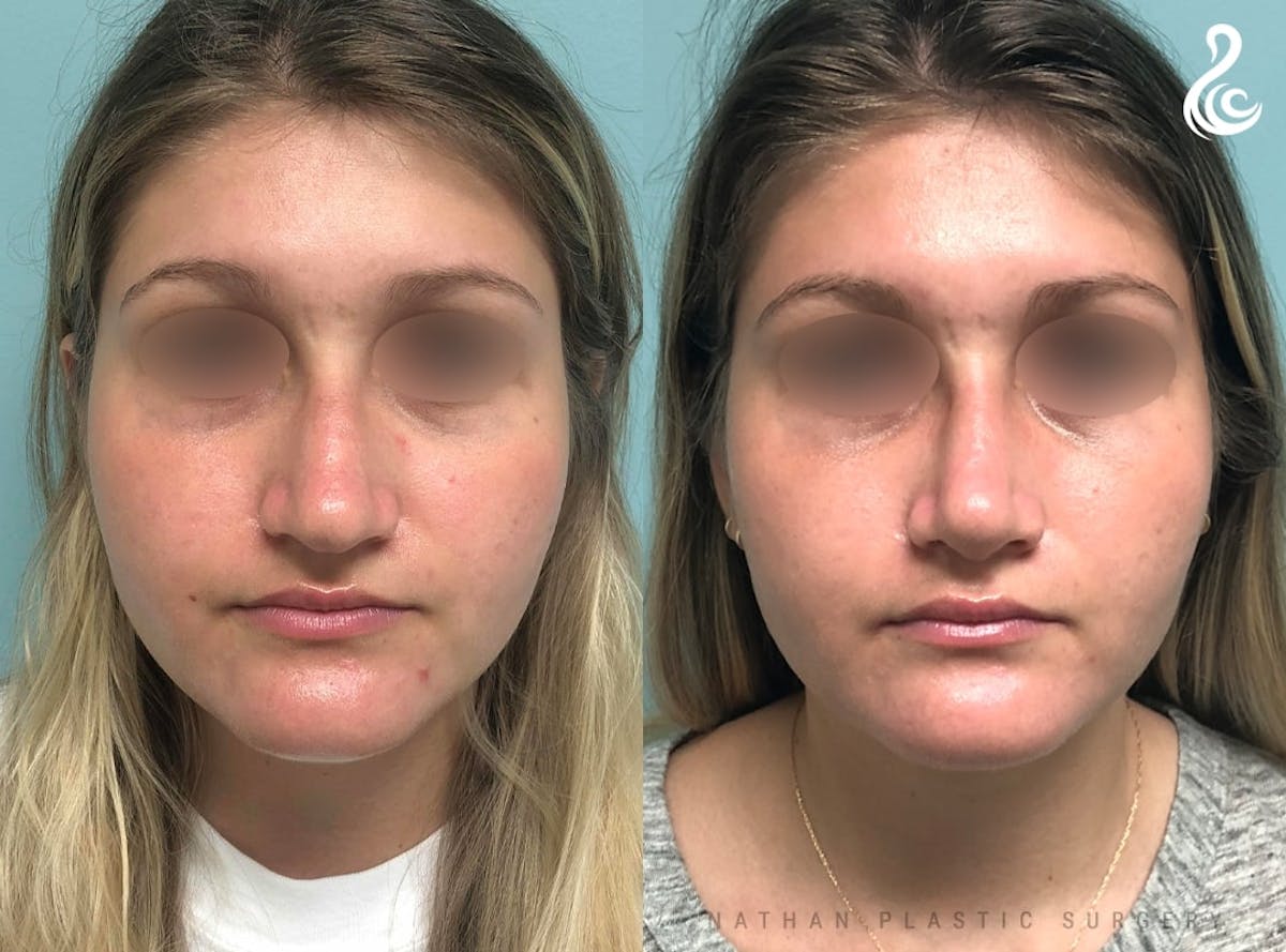 Rhinoplasty Before & After Gallery - Patient 380058 - Image 3