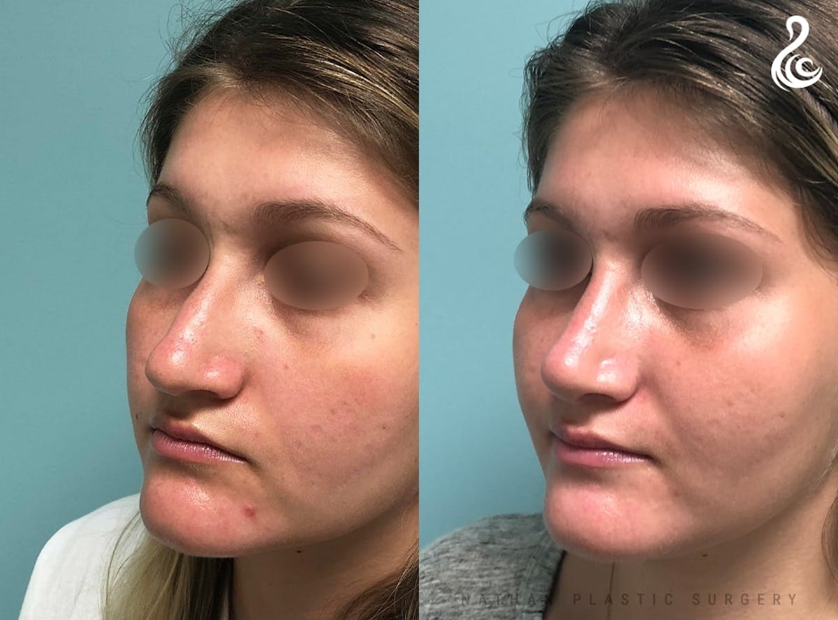 Rhinoplasty Before & After Gallery - Patient 380058 - Image 4