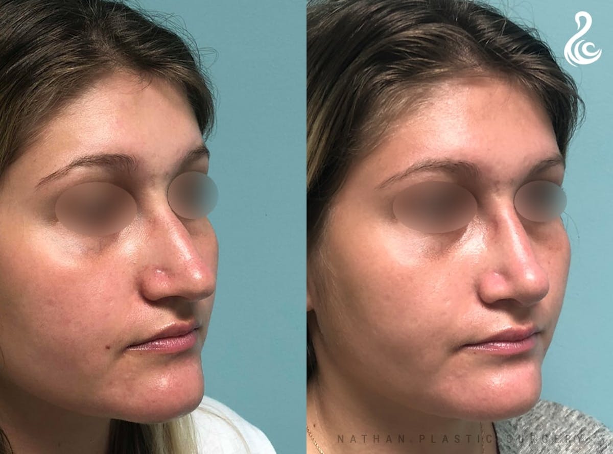 Rhinoplasty Before & After Gallery - Patient 380058 - Image 5