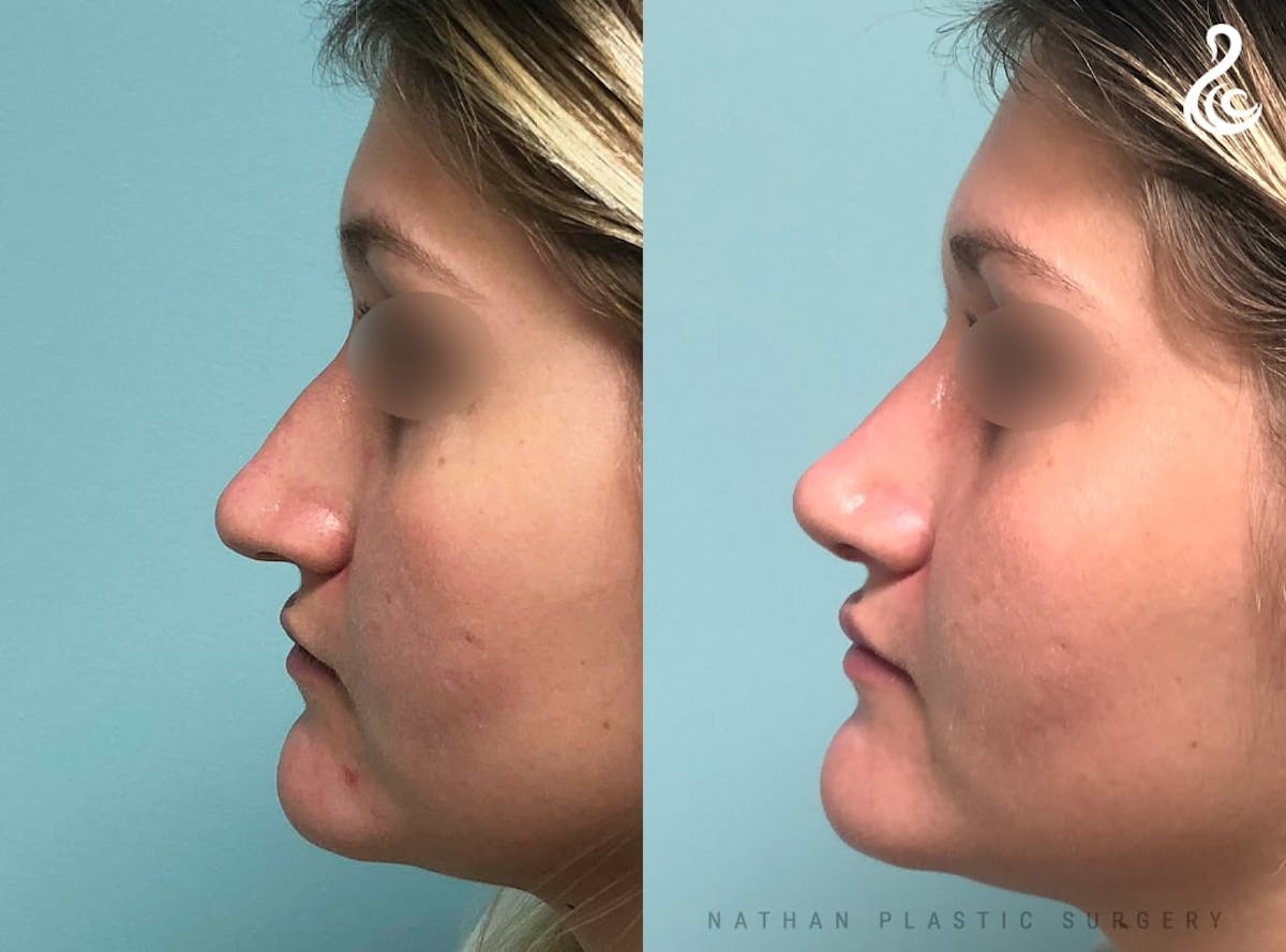 Rhinoplasty Before & After Gallery - Patient 380058 - Image 1
