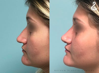 Rhinoplasty Before & After Gallery - Patient 380058 - Image 1