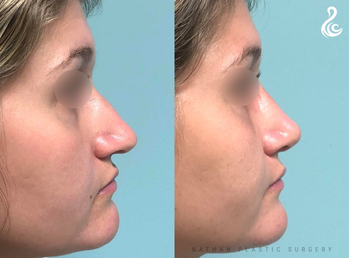 Rhinoplasty Before & After Gallery - Patient 380058 - Image 2