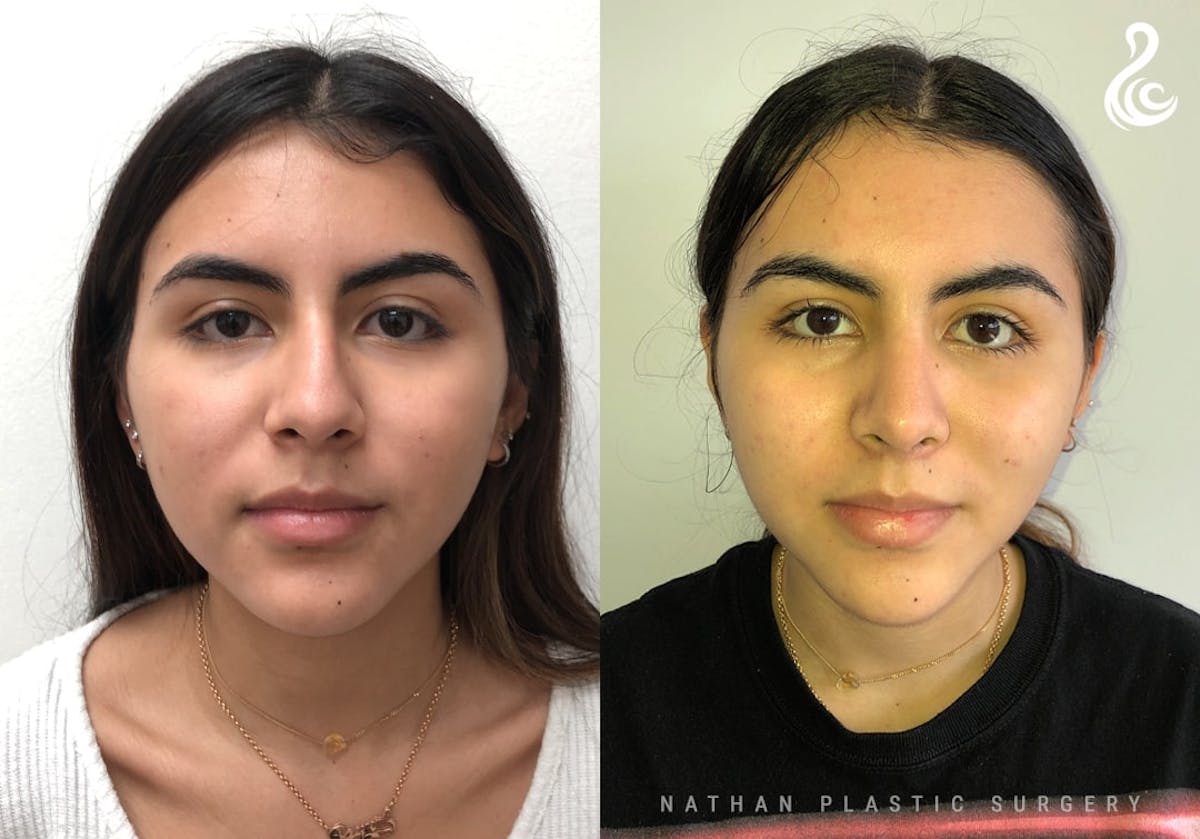 Rhinoplasty Before & After Gallery - Patient 287260 - Image 3