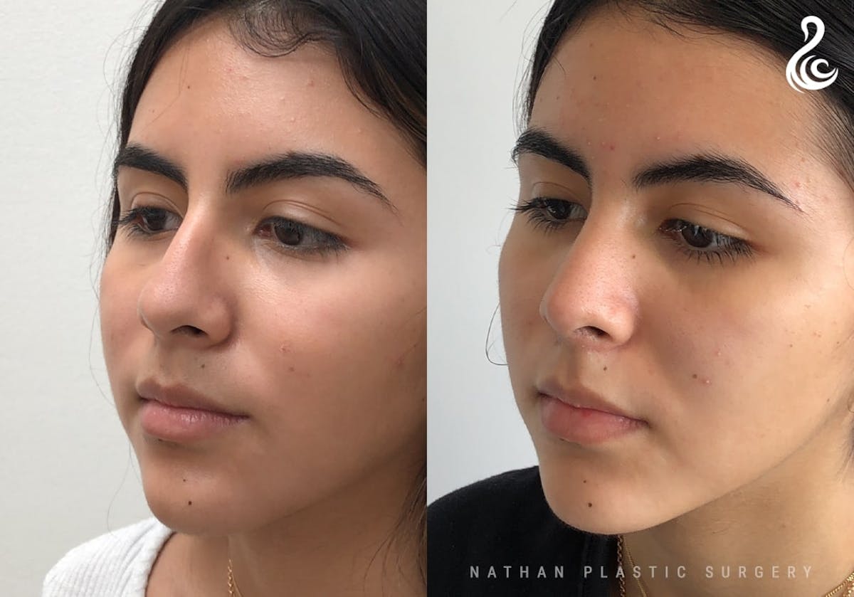 Rhinoplasty Before & After Gallery - Patient 287260 - Image 4