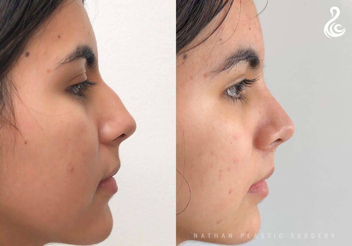 Rhinoplasty Before & After Gallery - Patient 287260 - Image 2