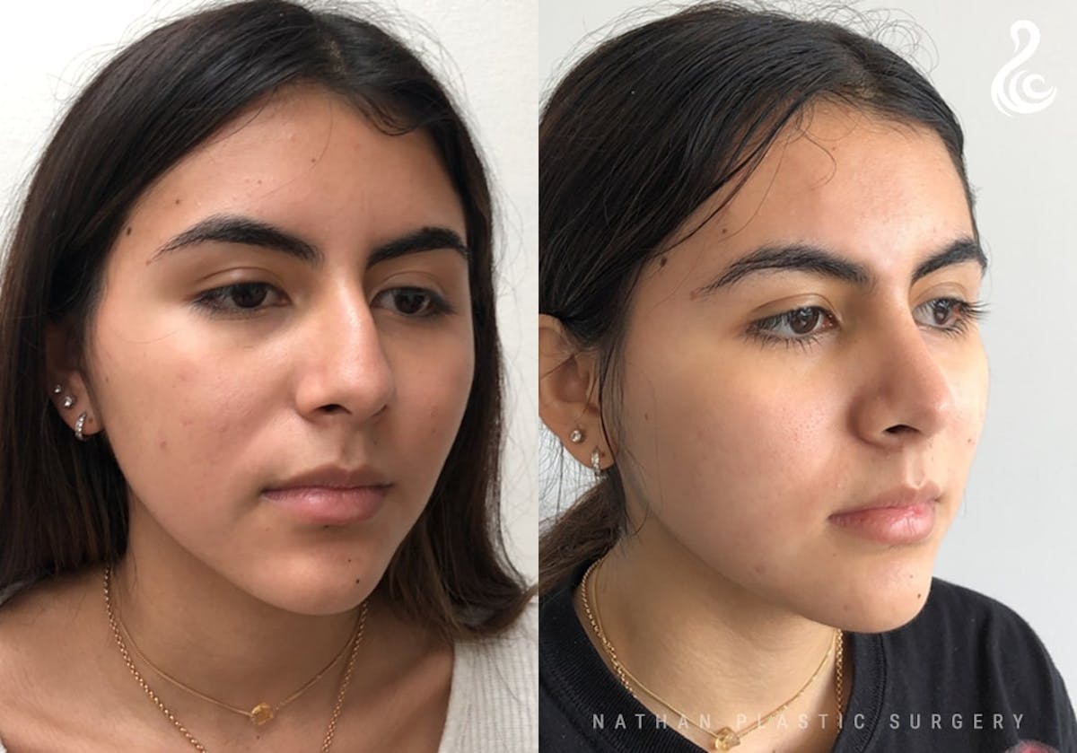 Rhinoplasty Before & After Gallery - Patient 287260 - Image 5