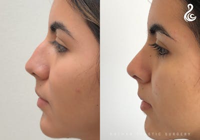 Rhinoplasty Before & After Gallery - Patient 287260 - Image 1