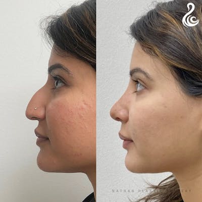 Rhinoplasty Before & After Gallery - Patient 109538 - Image 1