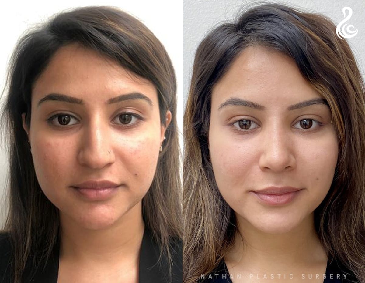 Rhinoplasty Before & After Gallery - Patient 109538 - Image 3