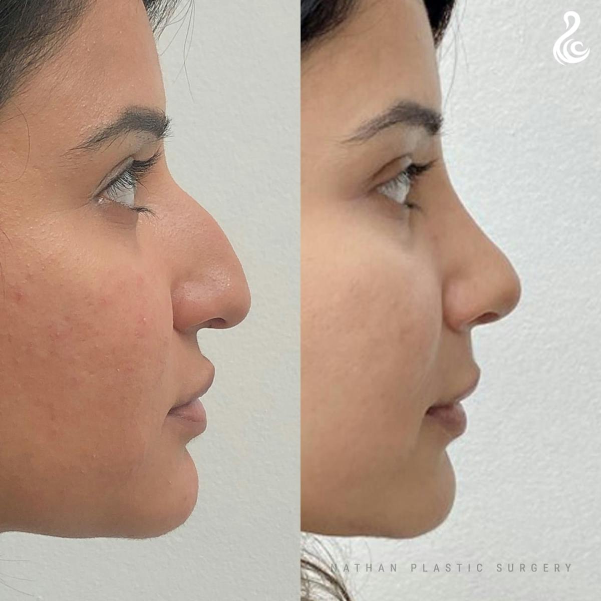 Rhinoplasty Before & After Gallery - Patient 109538 - Image 2