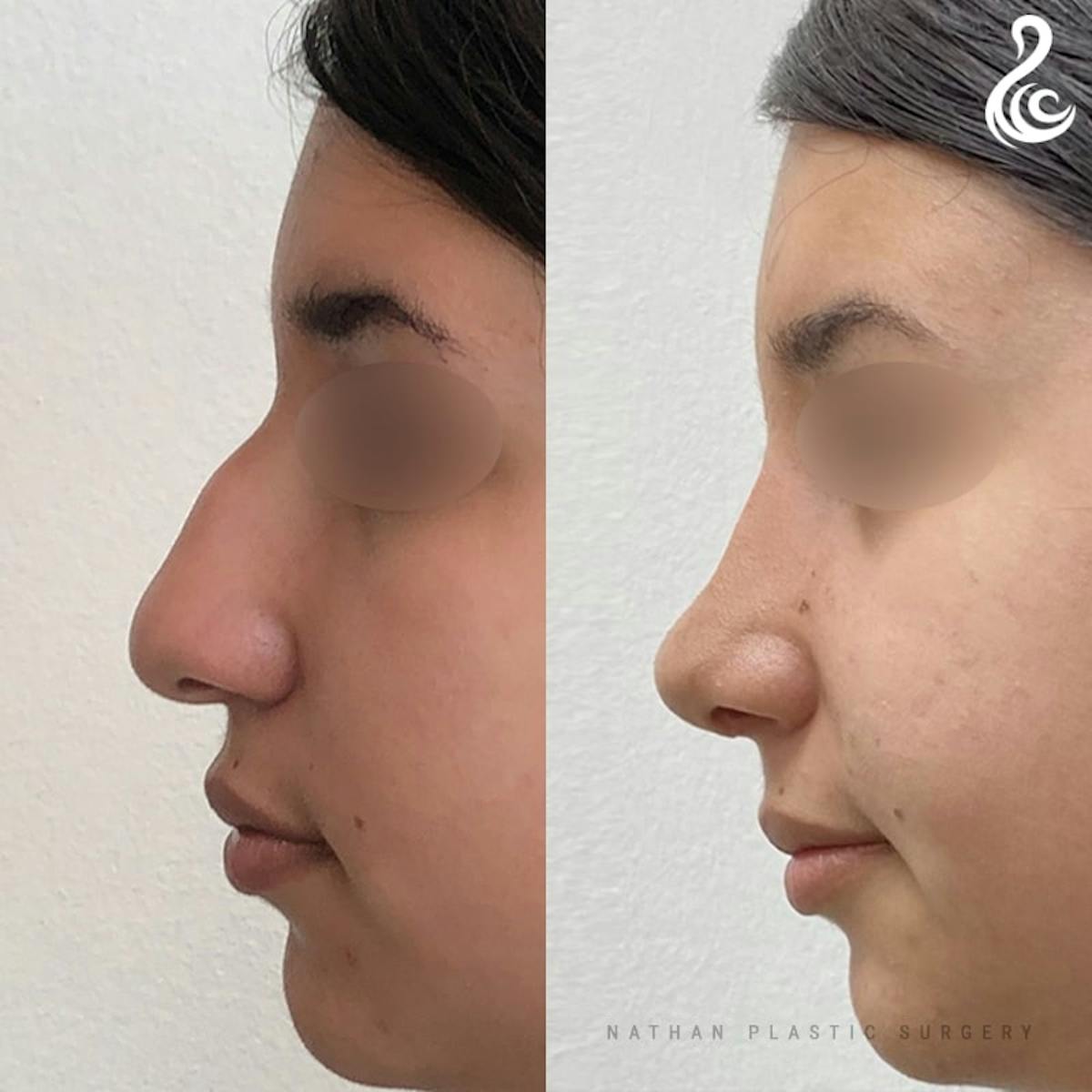 Rhinoplasty Before & After Gallery - Patient 323100 - Image 1