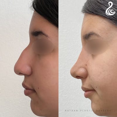 Rhinoplasty Before & After Gallery - Patient 323100 - Image 1
