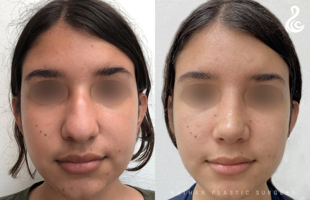 Rhinoplasty Before & After Gallery - Patient 323100 - Image 3