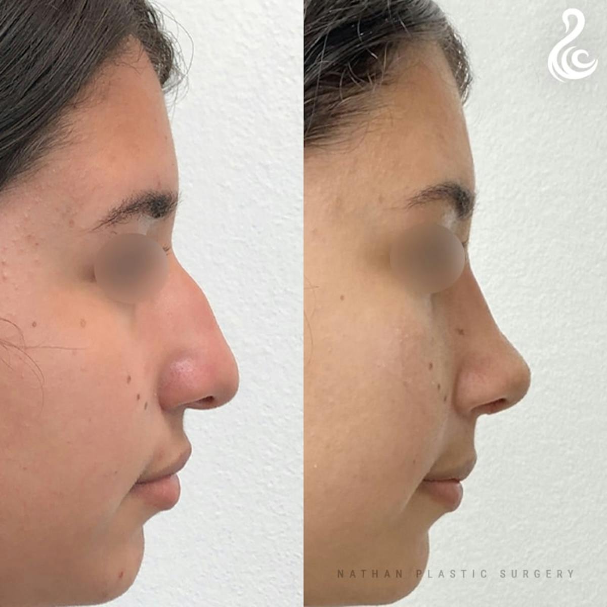 Rhinoplasty Before & After Gallery - Patient 323100 - Image 2