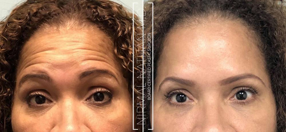 Botox Fir Imithe Mícheart Masseter Botox Treatment Aesthetic Beauty