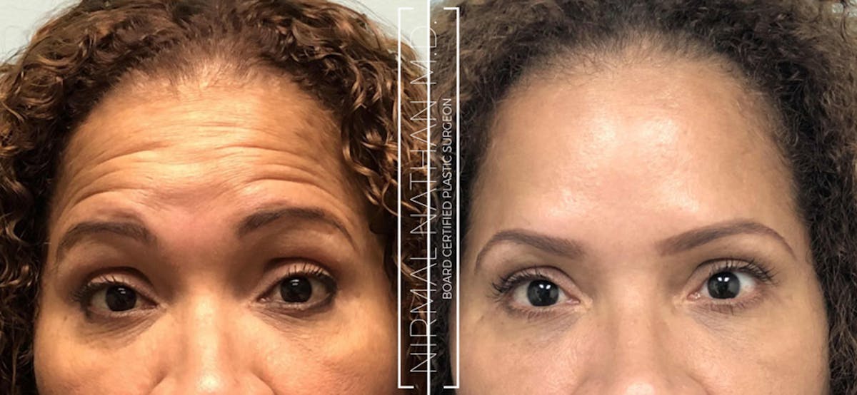 Botox Before & After Gallery - Patient 226732 - Image 1