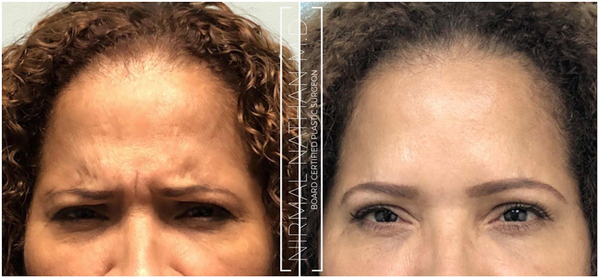 Botox Before & After Gallery - Patient 226732 - Image 2