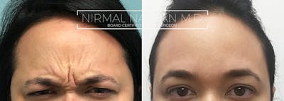 Botox Before & After Gallery - Patient 285907 - Image 1