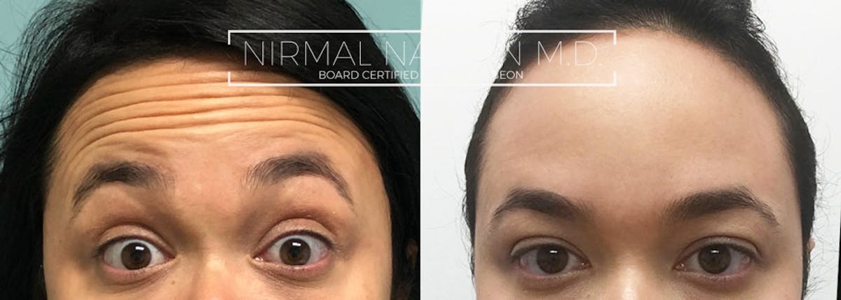 Botox Before & After Gallery - Patient 285907 - Image 2