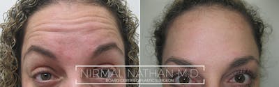Botox Before & After Gallery - Patient 145950 - Image 1