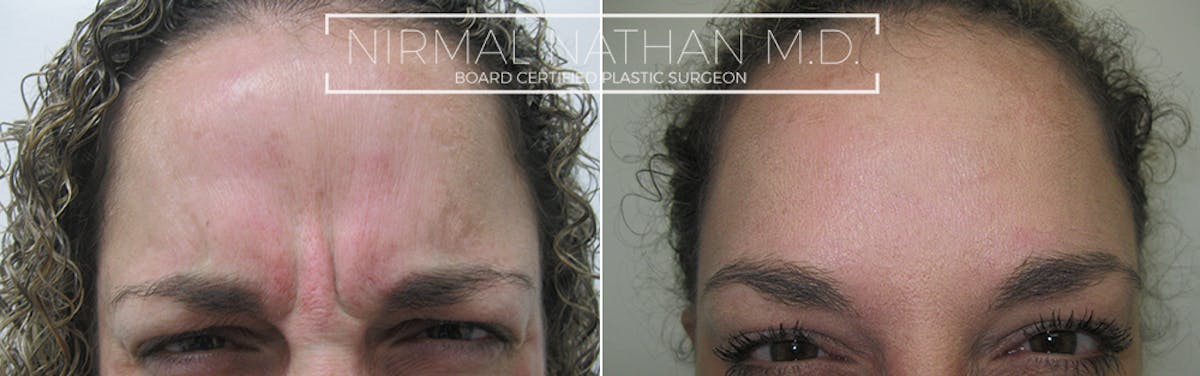 Botox Before & After Gallery - Patient 145950 - Image 2