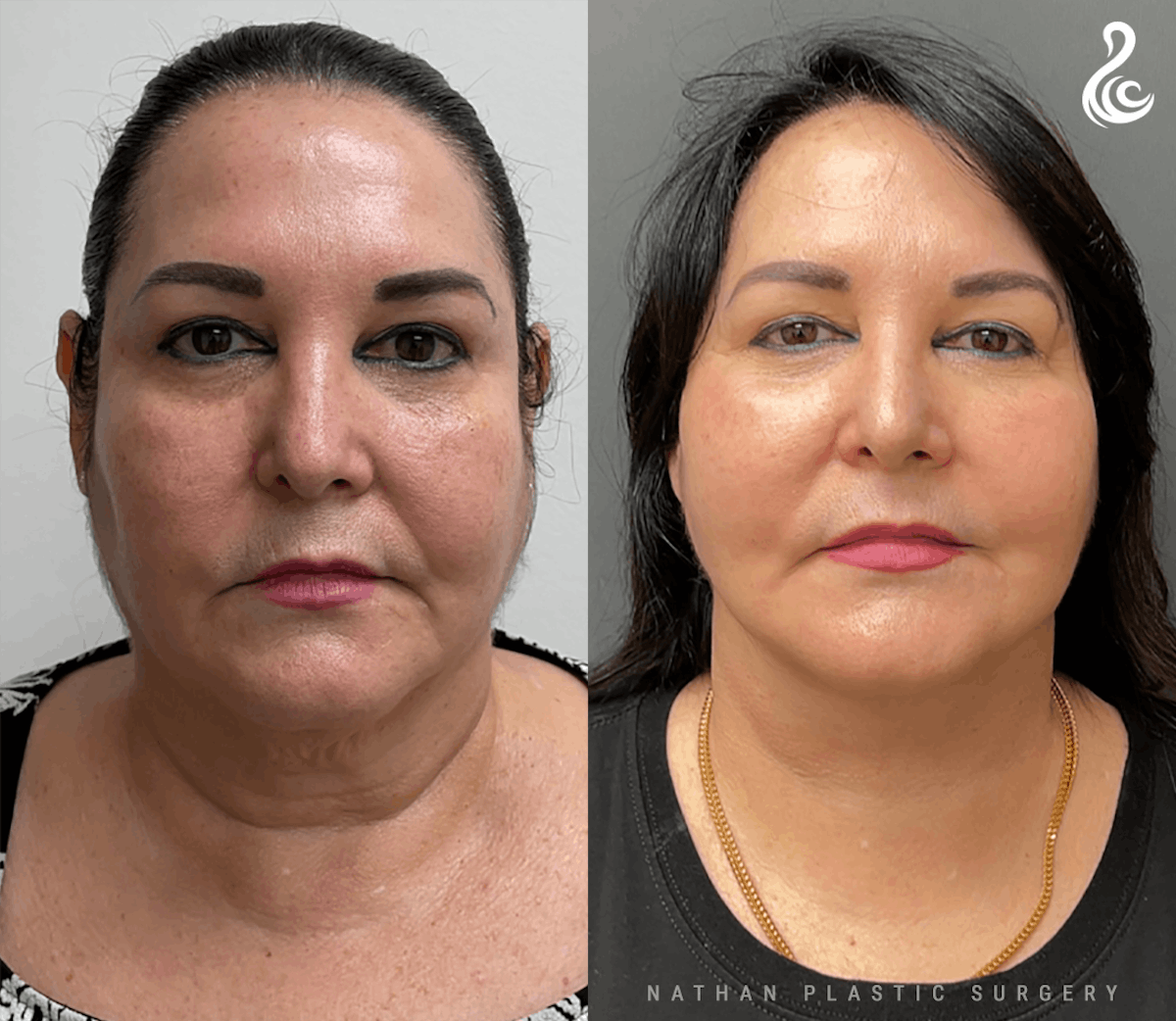 Facelift Before & After Gallery - Patient 170380 - Image 1