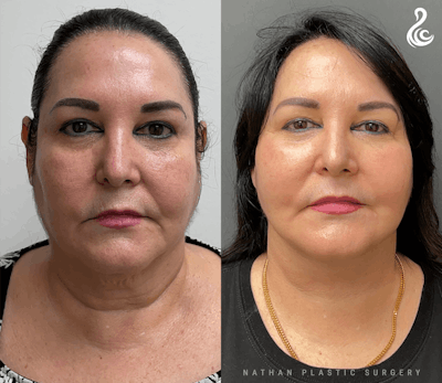 Facelift Before & After Gallery - Patient 170380 - Image 1